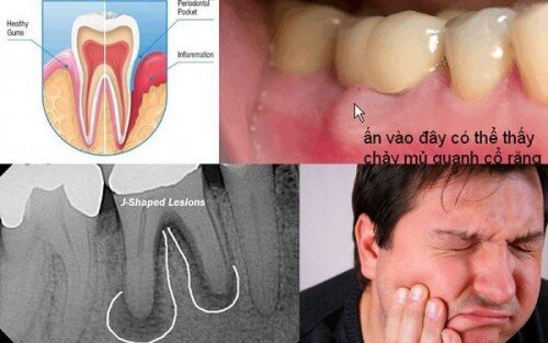 Làm sao để phát hiện ra bệnh viêm quanh chân răng ?