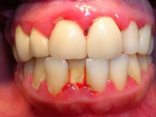 Làm sao để phát hiện ra bệnh viêm quanh chân răng ?
