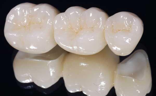 Độ bền của răng sứ Cercon HT tối đa là bao nhiêu?