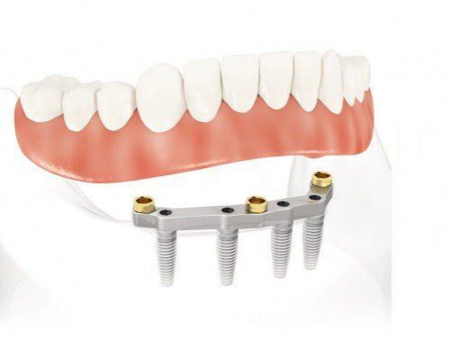 Ghép implant trong trường hợp mất răng hoàn toàn