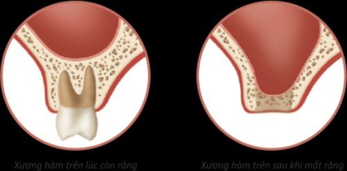 Ghép xương và nâng xoang hàm trong trồng răng implant