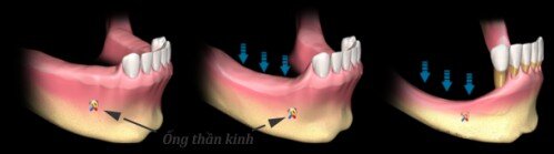 Ghép xương và nâng xoang hàm trong trồng răng implant