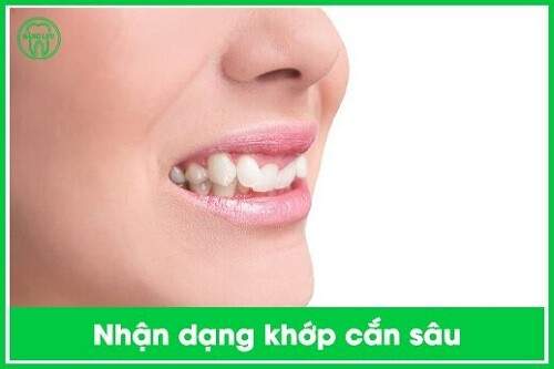 Giải pháp niềng răng điều trị khớp cắn sâu? 1
