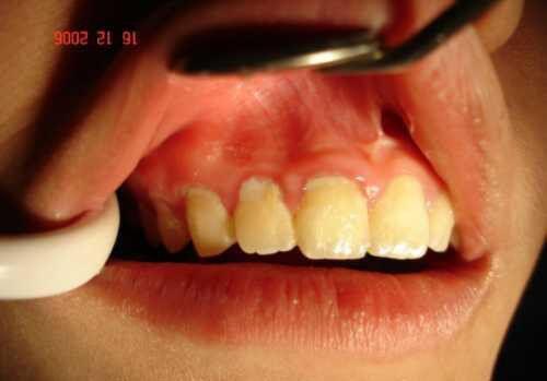 Chân răng bị bong tróc là bệnh gì ?