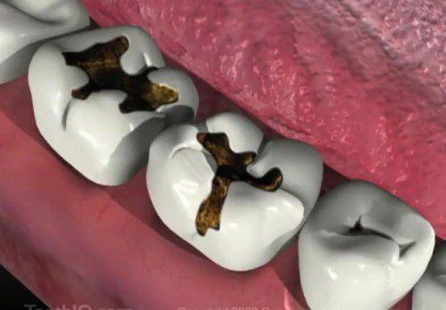 hậu quả và biến chứng của sâu răng