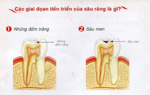 hậu quả và biến chứng của sâu răng