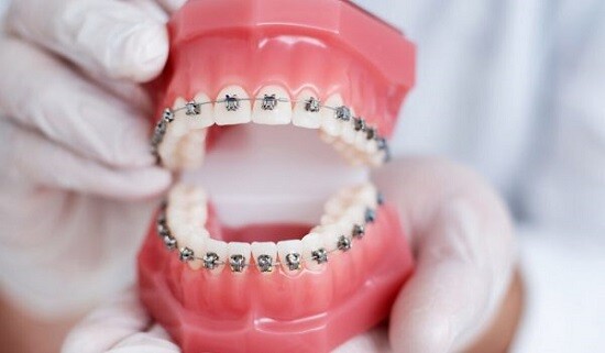 Quá trình niềng răng như thế nào-1