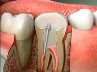 Hình thể lâm sàng và triệu chứng viêm tủy răng