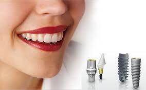 So sánh làm cầu răng và trồng răng Implant