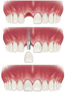 lợi ích của việc cấy ghép răng implant