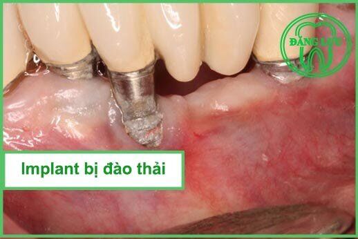 răng Implant bị đào thải trồng lại có đau không?