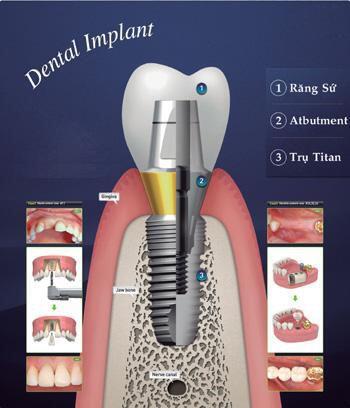 Khoe nụ cười tỏa sáng với phương pháp cấy ghép Implant