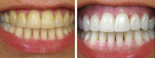 Nhìn màu sắc răng đoán sức khỏe răng miệng