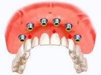Làm răng giả nguyên hàm