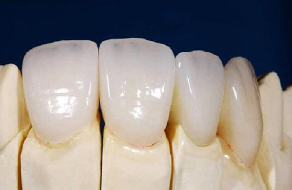 Làm răng sứ Cercon HT duy trì được tối đa bao nhiêu năm?