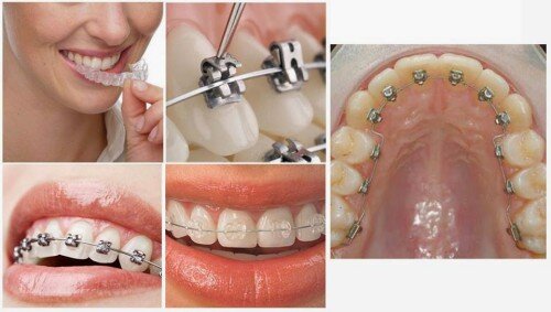 Niềng răng khắc phục tình trạng thưa răng 