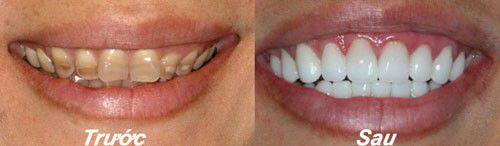 Chữa răng nhiễm màu nặng bằng phương pháp bọc răng sứ