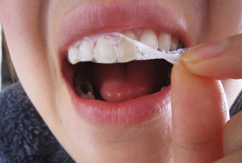 Tẩy trắng răng tại nhà có an toàn không ? 