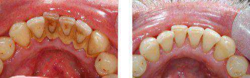 Răng miệng gặp nguy hiểm vì cao răng