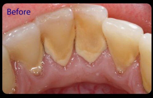 Dấu hiệu và triệu chứng bệnh viêm chân răng  
