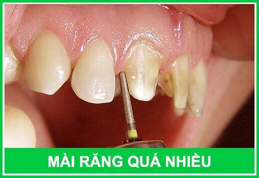 nguyên nhân khiến răng bị viêm tủy sau khi bọc sứ