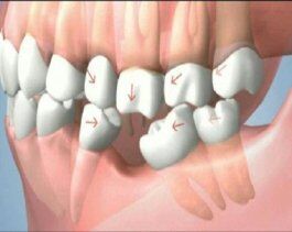Mất răng cấm có ảnh hưởng sức khoẻ không?