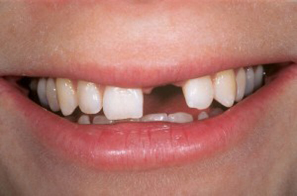 Mất răng và hậu quả của việc mất răng lâu ngày