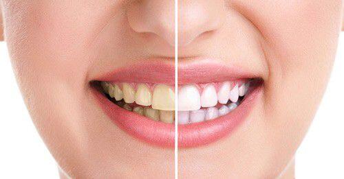 Lấy cao răng thường xuyên nhưng bộ nhai vẫn ố vàng