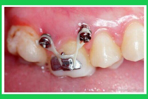 Phương pháp niềng răng với Minivis là gì? Có đau không?-1