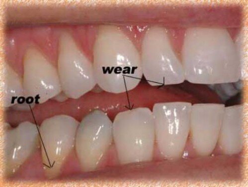 Mòn răng, tụt lợi vì vệ sinh răng quá thường xuyên