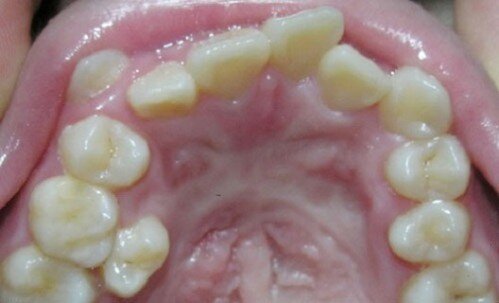 Một số vấn đề bất thường ở bộ răng hỗn hợp
