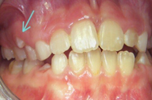 Một số vấn đề bất thường ở bộ răng hỗn hợp