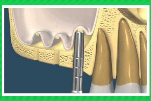 Nâng xoang hàm khi cấy ghép implant