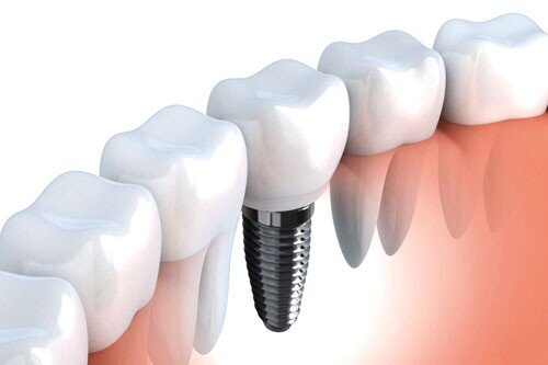 Nên bọc răng sứ hay cấy ghép implant ?