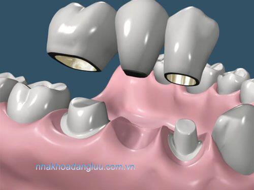 Nên bọc răng sứ hay cấy ghép implant