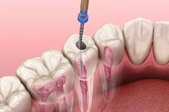 Nguy hiểm tiềm ẩn từ bệnh viêm tủy răng 1
