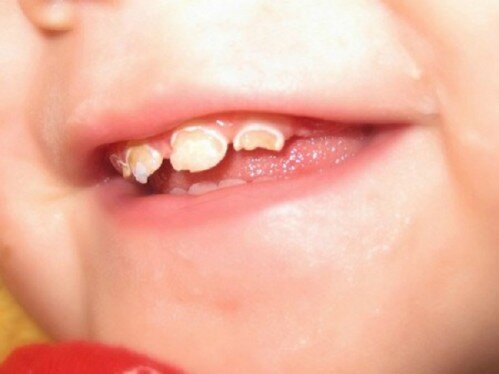 Nguyên nhân khiến răng trẻ em bị mủn nát
