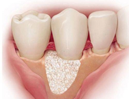 Nguyên nhân gây mất răng sớm