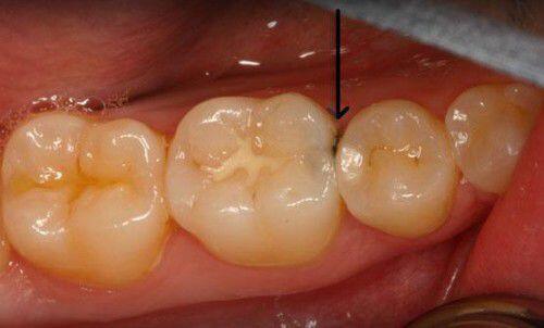 Khi nào trám răng không cần lấy tủy ?