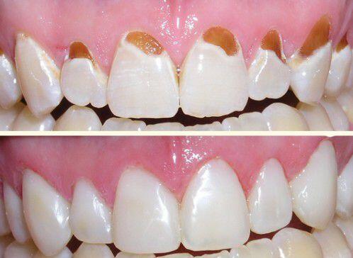 nguyên nhân gây sâu răng và cách điều trị