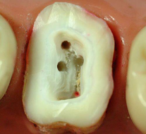 Điều trị tủy răng là gì ?