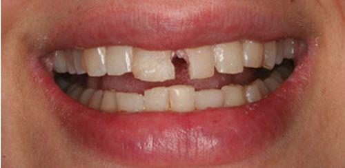 Biến chứng chảy máu kéo dài sau nhổ răng