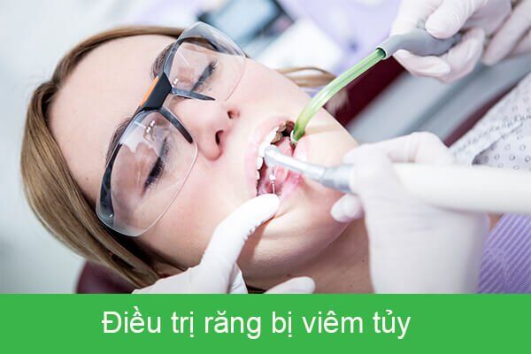 điều trị viêm tủy răng
