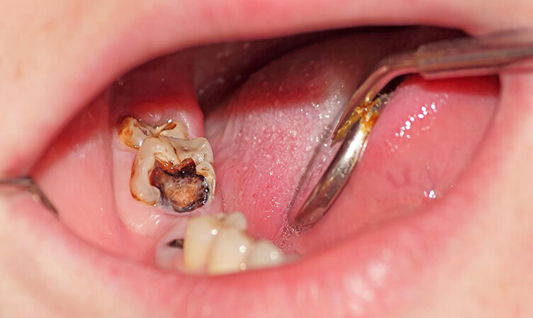 Nguyên nhân nhổ răng là gì