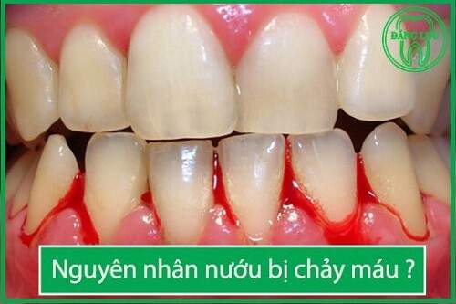 Nguyên nhân nướu răng bị chảy máu và cách phòng tránh 1