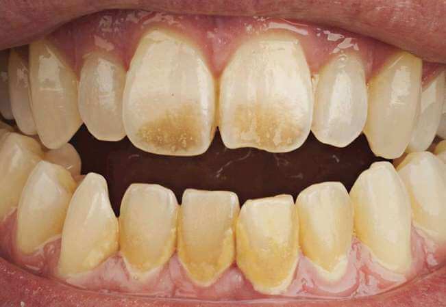 nguyên nhân răng bị ố vàng