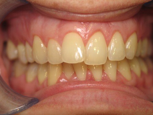 Cách phòng ngừa tình trạng mất màu răng từ bên trong