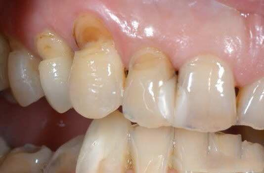 Nguyên nhân và cách điều trị mòn cổ răng