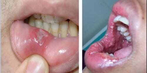 Bệnh răng miệng và những cảnh báo về sức khỏe