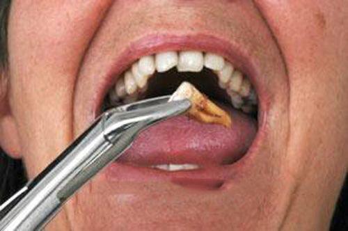 Nhổ răng hàm không đau